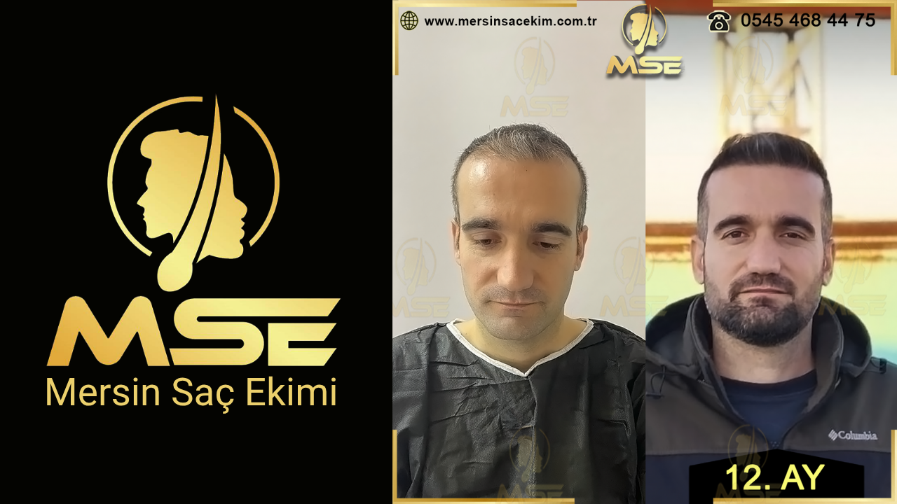 MERSİN SAÇ EKİMİ